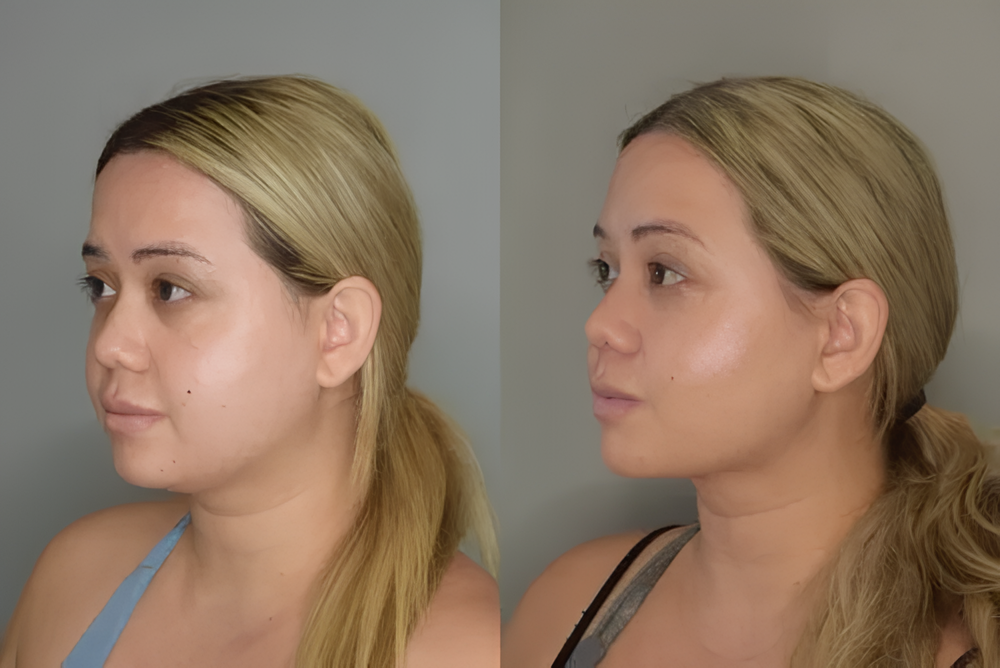 Mudança percebida no contorno facial